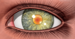 cataracts 2